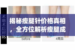 揭秘瘦腿針價(jià)格真相，全方位解析瘦腿成本！