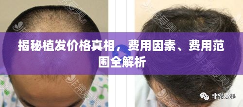 揭秘植發(fā)價格真相，費用因素、費用范圍全解析