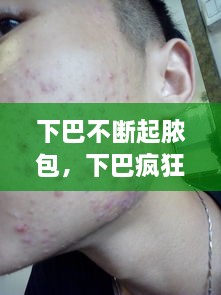 下巴不斷起膿包，下巴瘋狂長膿包 